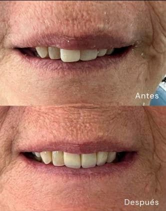 Caso de éxito - paciente Dr. Zeus Rilo, rehabilitación oral