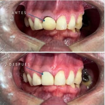 Caso de éxito - paciente Dental Rilo, tratamiento dental especializado