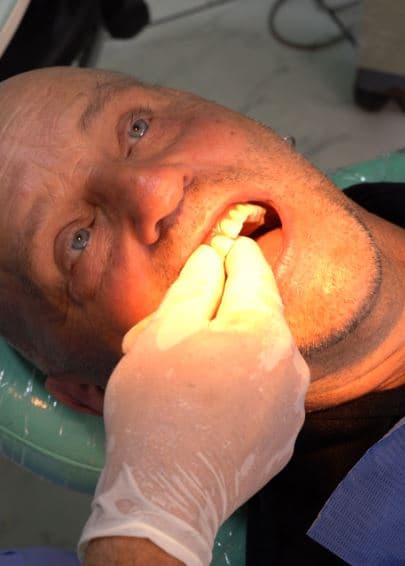 Caso de éxito - paciente del exterior, implantes dentales en Lima