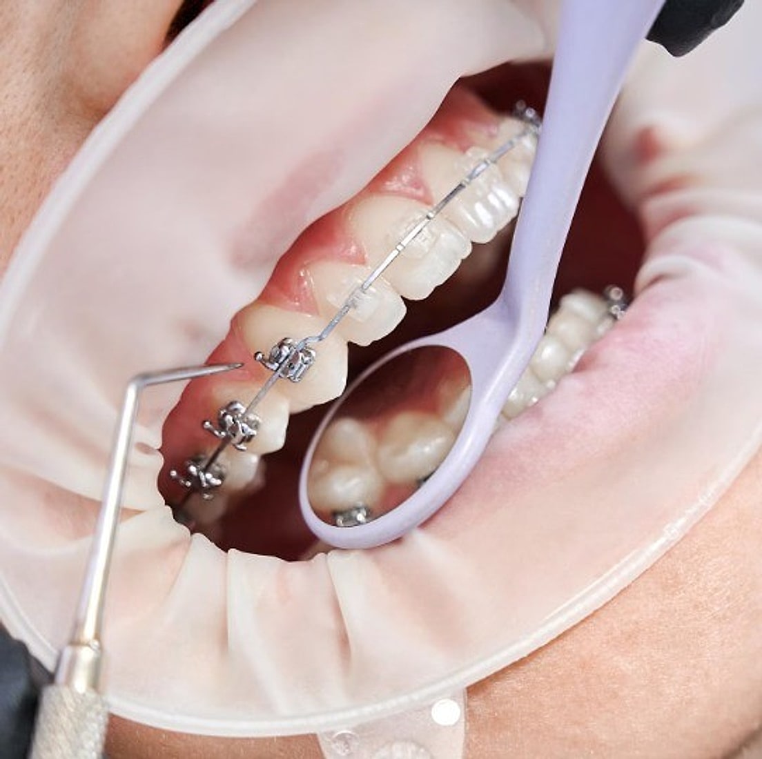 Tratamiento de ortodoncia con brackets metálicos durante un control clínico