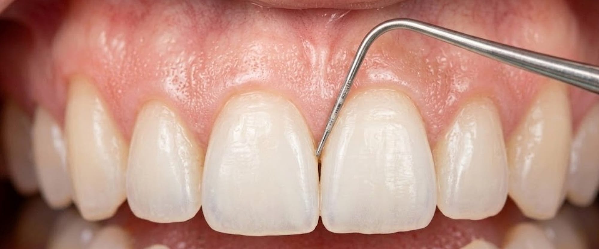 Tratamiento periodontal de encías con instrumento dental especializado, Dental Rilo, Lima